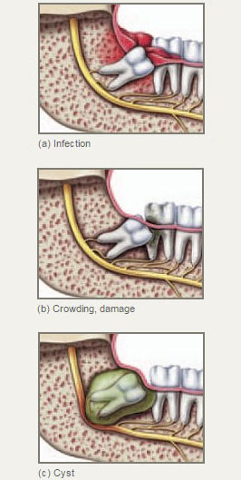 Impacted-Teeth