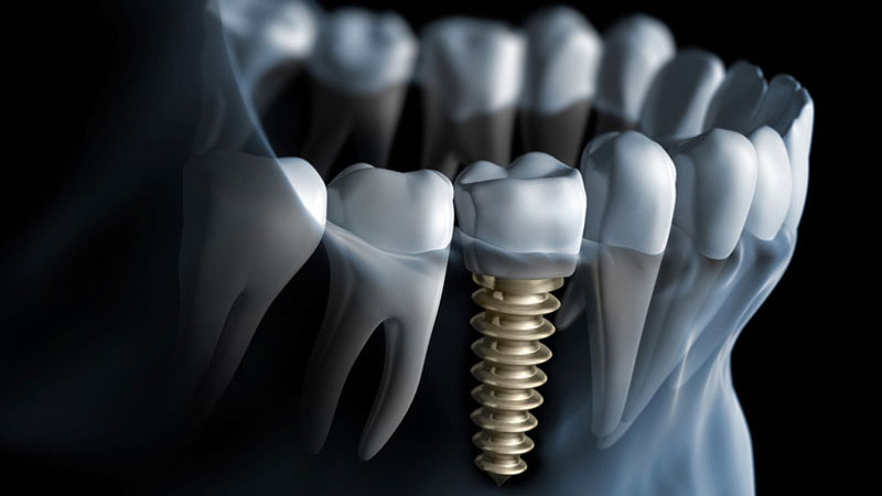 Implant Dentistry