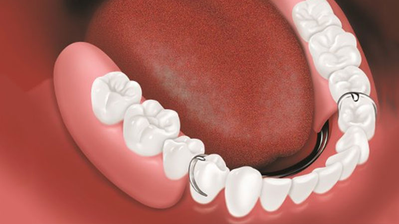 Partial_Denture