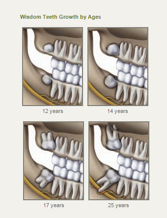 wisdom-teeth