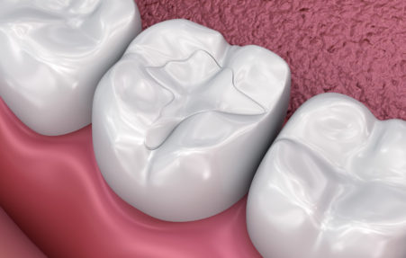 White composite resin dental fillings